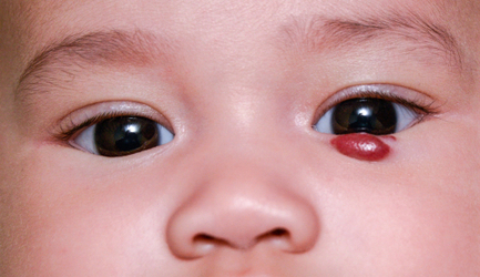 המנגיומה - תמונת אווירה